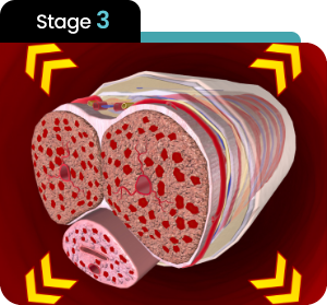 Stage 3 — Full Vascular Response