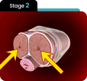 Stage 2 — Nitric Oxide Released