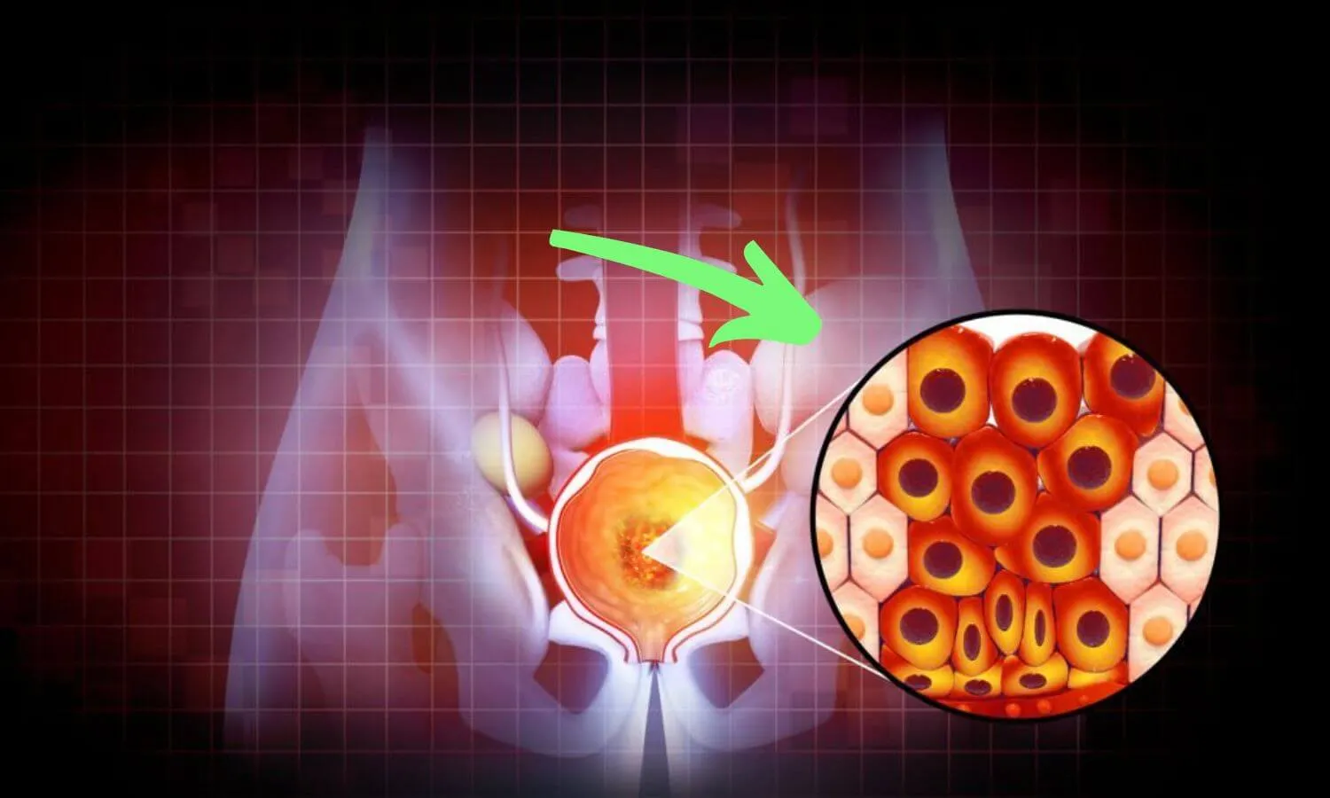 Educational image illustrating prostate enlargement and urinary flow