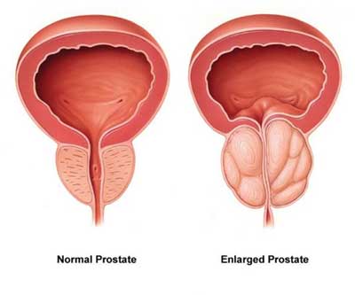 Normal prostate vs enlarged prostate illustration