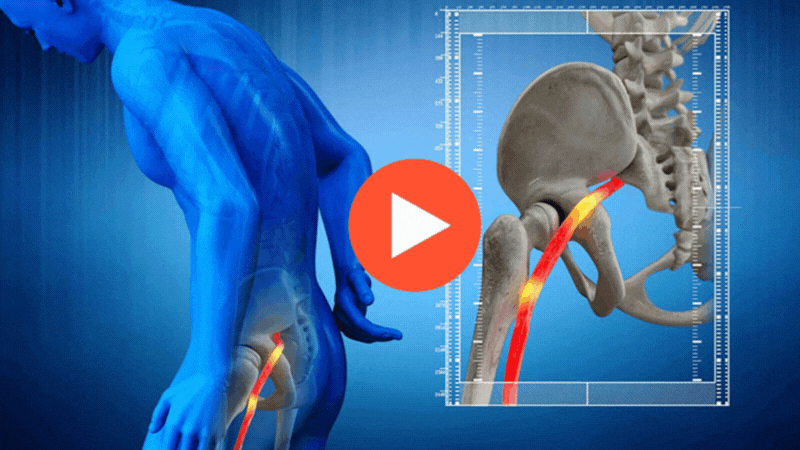 imag-sciatica-pain-relief